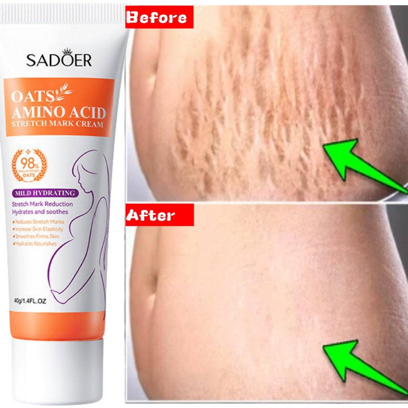 Stretch Marks Permanent Remova - Skincare Oat ulasan dan harga