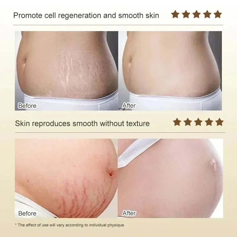 Stretch Marks Permanent Remova - Skincare Oat ulasan dan harga