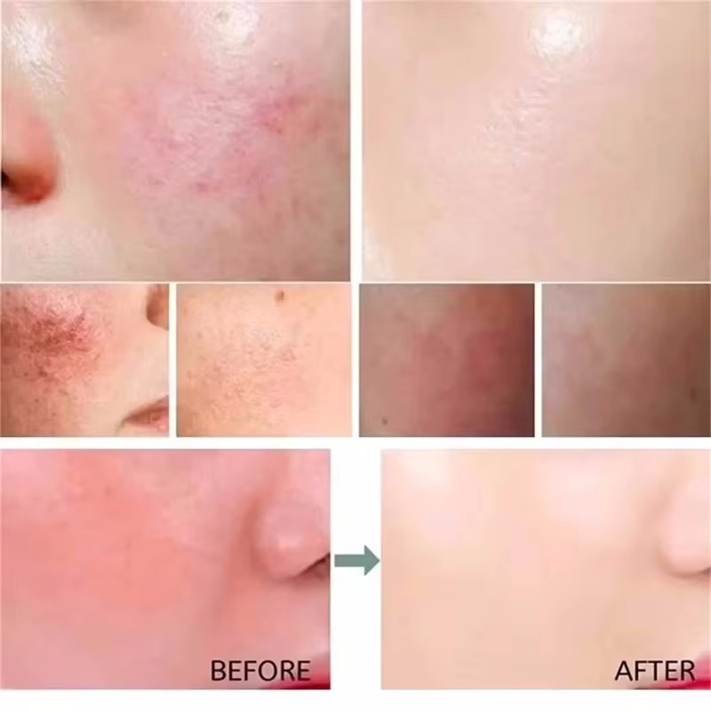 Facial Redness Repair Serum Im - Azelaic Acid Serum ulasan dan harga