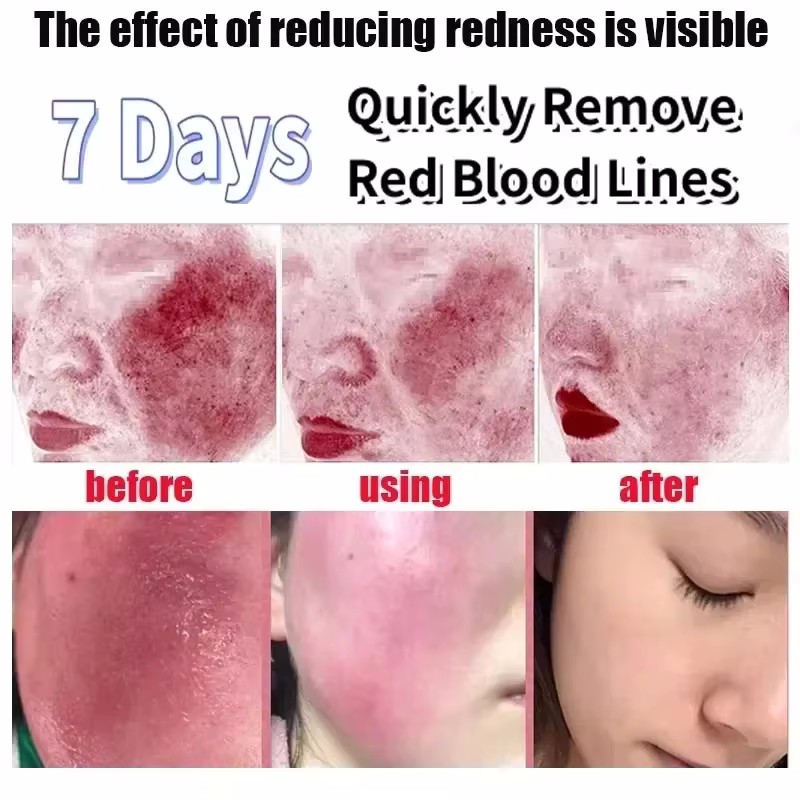 Facial Redness Repair Serum Im - Azelaic Acid Serum ulasan dan harga